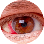 glaucoma